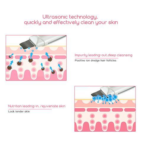 Ultrasonic Skin Scrubber – Deep Facial Cleansing & Blackhead Removal